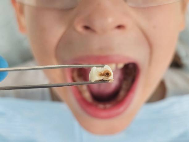 Best Emergency Broken Tooth Repair in Reidland, KY